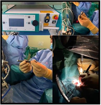 Safeness and efficacy of 2-µm handheld thulium laser during microsurgical resection of supratentorial and infratentorial meningiomas: Experience of a single center